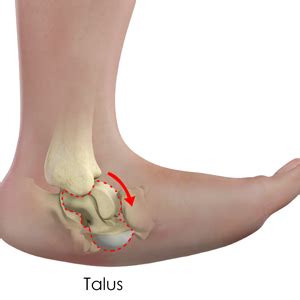 Vertical Talus | Ankle Pain Blue Mountains | Blacktown