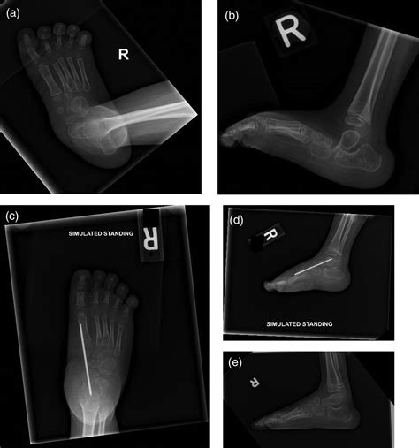 Untreated congenital vertical talus deformity in walking age ...