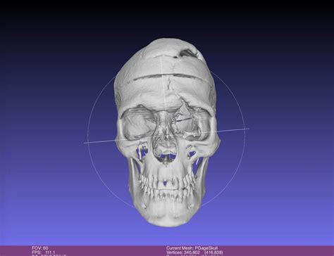 Phineas Gage Skull, harvard CT SCAN, Museum Quality High Resolution STL ...