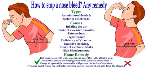 nose bleed(epistaxis) ,how to manage?