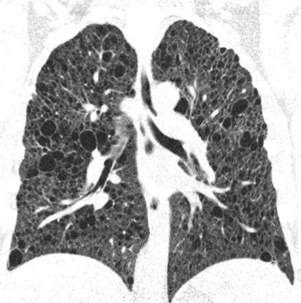 Playlist 'Cystic lung disease' by Dr Greg Tarr