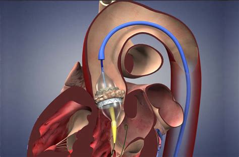 Aortic Valve Replacement Now Made Very Simple - ehealth quotes