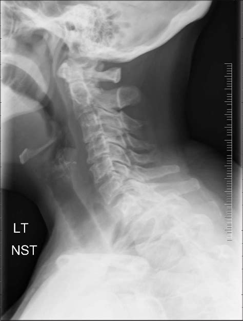 Figure 1 from Drug-induced Angioedema: A Rare Side Effect of Mirabegron ...