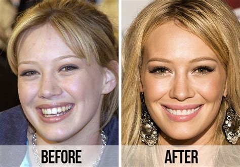 21 Celebrity Dental Implants And Veneers: Before And After - SHEfinds