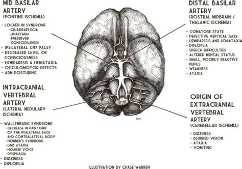 Vertebrobasilar Artery Occlusion - The Western Journal of Emergency ...