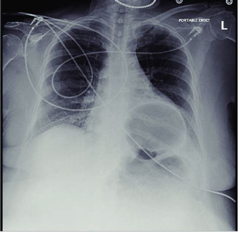 Chest X-ray showing herniation of the gas-distended stomach overlying ...