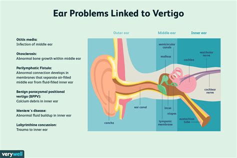 Vertigo cause - kesilmulti