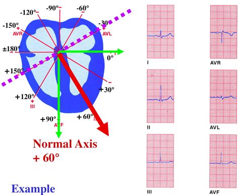 QRS Determination