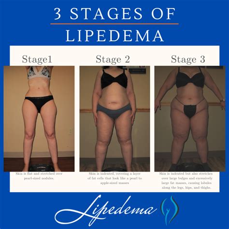 symptoms of lipedema Archives - Lipedema