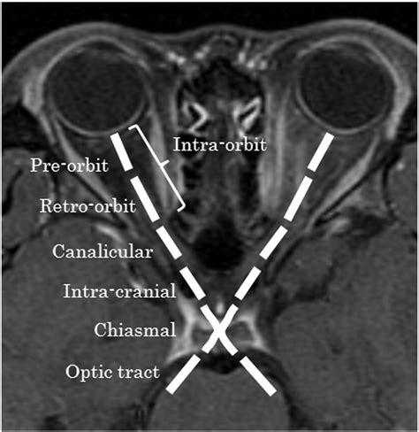 Lesion length of optic neuritis impacts visual prognosis in ...