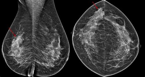 Mammography Images: Understanding Your Results - Evolving World