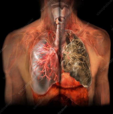 Healthy Lung vs. Smoker's Lung - Stock Image - C038/3695 - Science ...