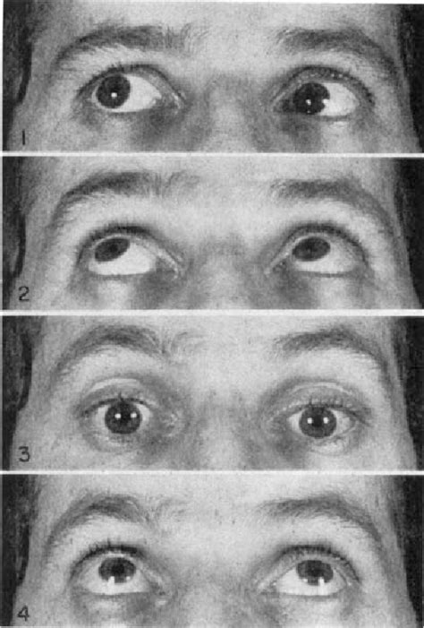 Figure 4 from Horizontal conjugate gaze in brain stem lesions ...