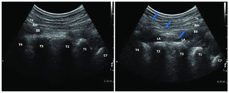 Ultrasound-guided erector spinae plane block. (a) before local ...