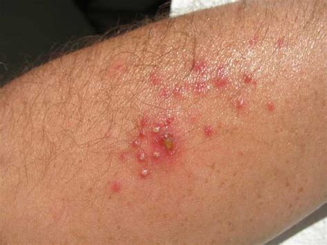 Skin Infection-Causing Agents | Patients Crossing Oceans