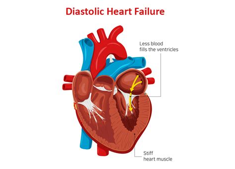 Know The Symptoms of Diastolic Dysfunction | Dr. Raghu