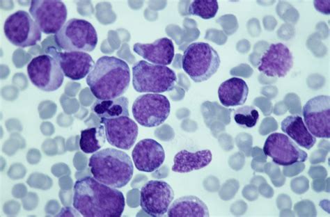 Microscopic Views of Leukemia and Lymphoma Blood Cancer