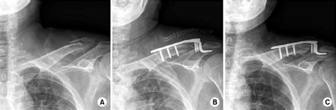 Figure 1 from Results of Hook Plate Fixation of Unstable Distal ...