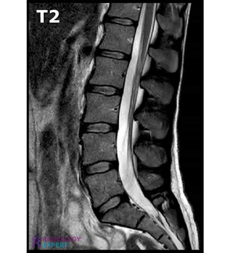 MRI Lumbar Spine