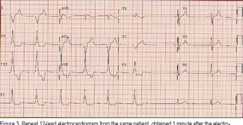 Figure 2 from ECG Diagnosis: Accelerated Idioventricular Rhythm ...