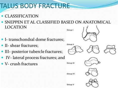 talus fracture