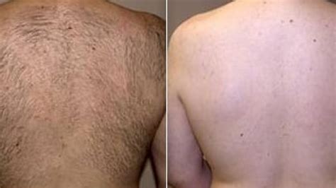 Laser Hair Removal Lincolnwood, Illinois - ForeverYoung MedSpa