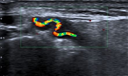 Temporal Artery Ultrasound