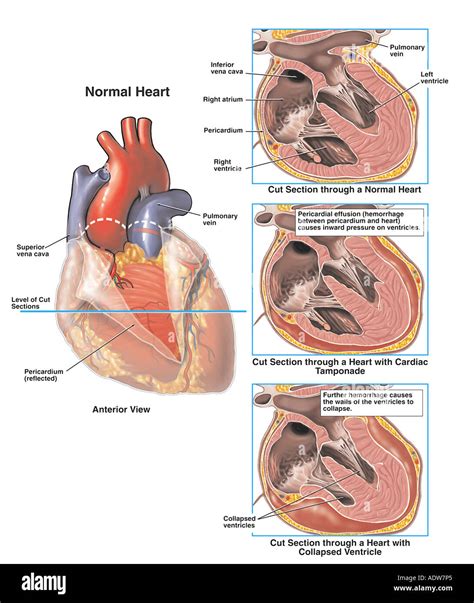 Cardiac Tamponade with Ventricular Collapse Stock Photo: 7712420 - Alamy