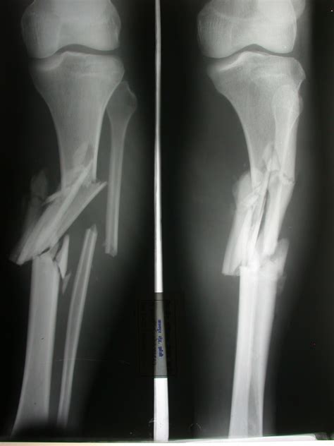 Science Life Bone Fractures 729 | The Best Porn Website