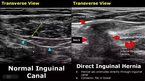 Indirect Vs Direct Inguinal Hernia