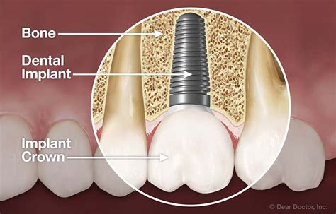 Implant Dentistry | Fall Creek Dental | Granbury Texas