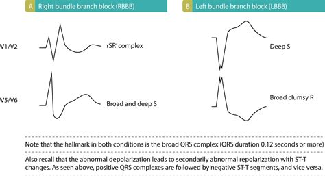 Left Bundle Branch Block Ecg