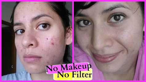 HOW I HEALED MY ACNE SCARS FAST - ROSE HIP SEED OIL BEFORE AND AFTER ...