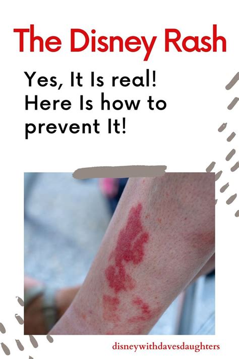 Disney Rash - What it is + How to Prevent it - Disney With Dave's ...