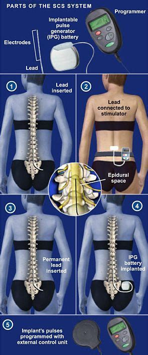 Pin on Diabetic Peripheral Neuropathy Treatment