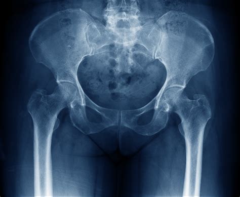 How Good are Hip X-rays and MRIs In Diagnosing the Cause of Hip Pain ...