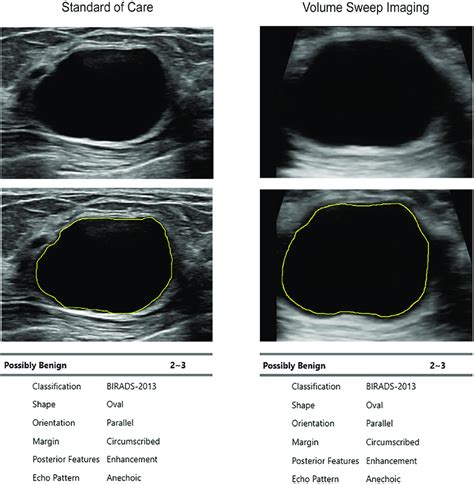 S-Detect Interpretation of a Cyst on Standard of Care and VSI. B-mode ...