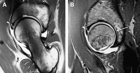 Osteoarthritis Mri