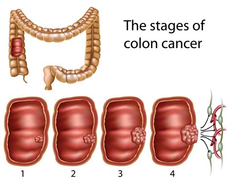 Colon Cancer Treatment: Colorectal Cancer Stages and Treatment Options