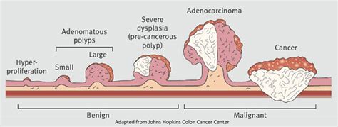 Stages Of Colon Polyps