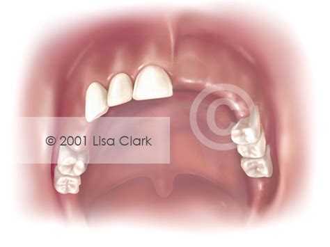 Dentures: Missing Teeth | Clark Medical Illustration