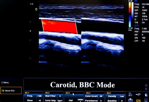 Carotid Duplex Ultrasound Tests & Procedures | NNS