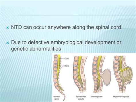 Neural tube defects