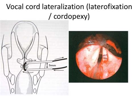 Doctors for Laryngeal Web Excision Surgery. Laryngeal web is a ...