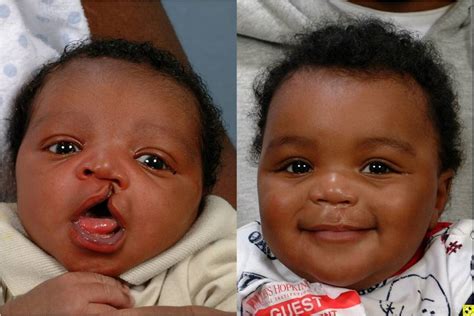 Cleft Lip/Palate Kids: Pre & Post Treatment Care