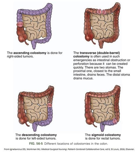 152 best Colostomy Info images on Pinterest | Crohn's disease ...