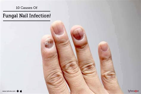 10 Causes Of Fungal Nail Infection! - By Skinovate Laser & Cosmetic ...