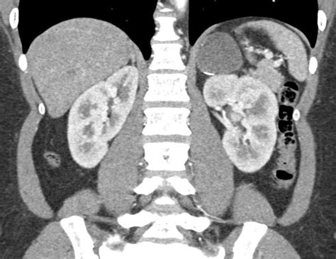 Left Adrenal Adenoma - Adrenal Case Studies - CTisus CT Scanning