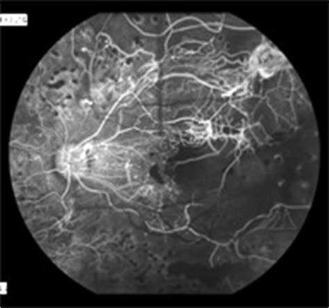 Fluorescein Angiography- Retina Ophthalmology in Frederick MD - Greater ...