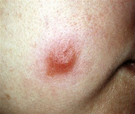 Leishmaniasis Images